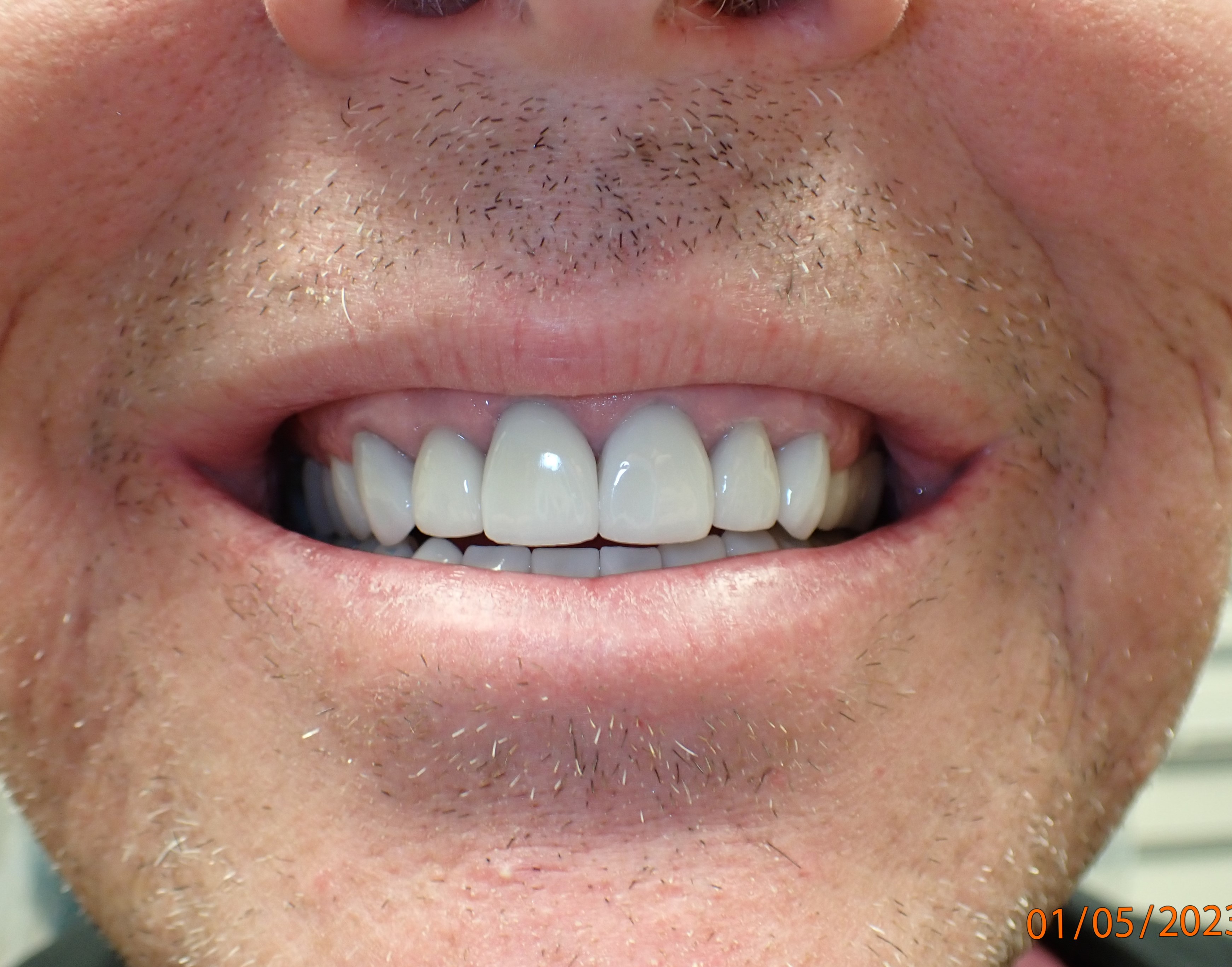 Man smiling to show teeth with veneers