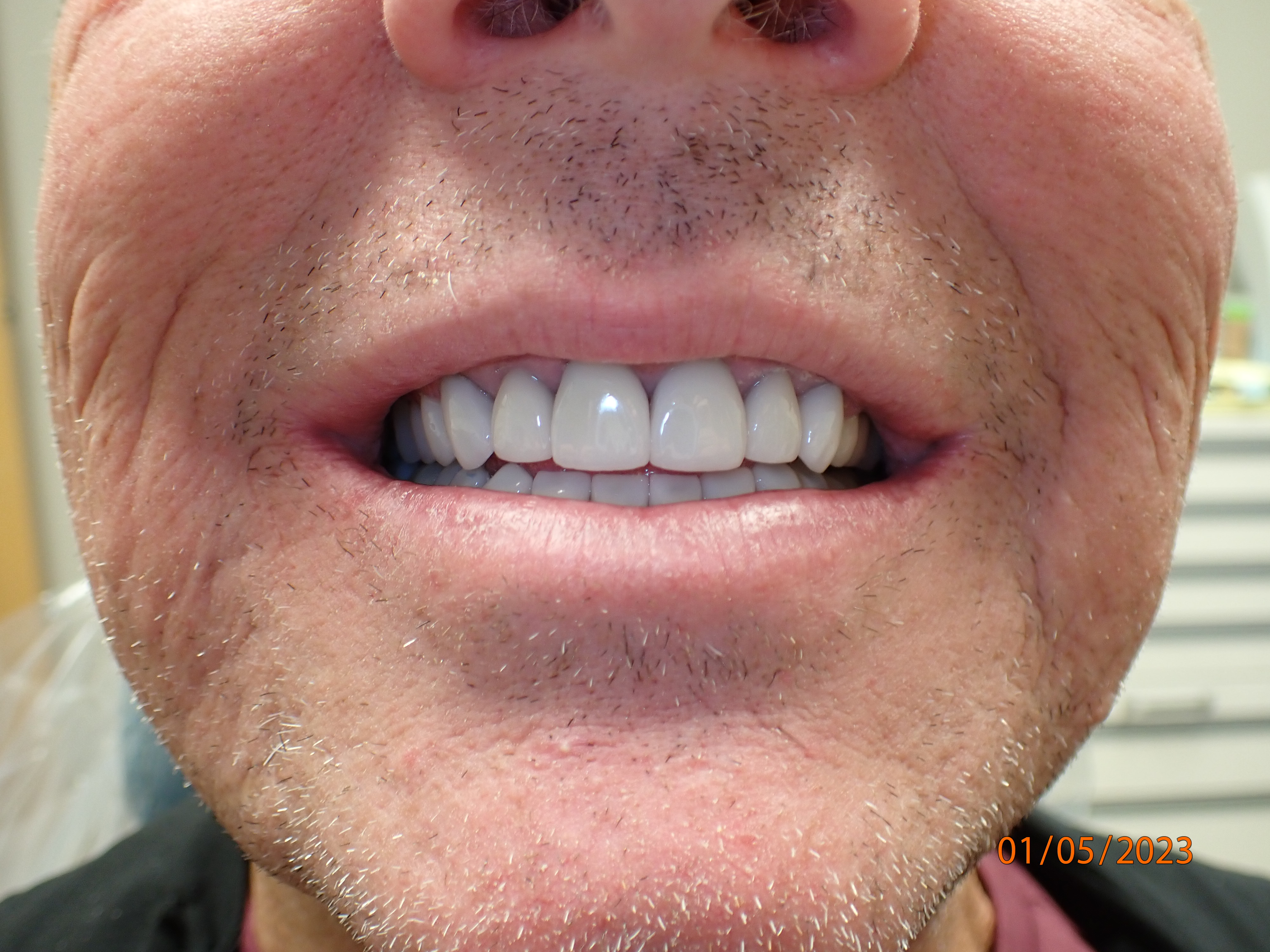 Slightly further shot of teeth after veneers