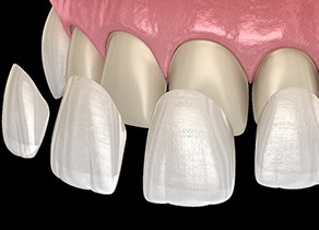 A digital image of veneers going on over the front teeth in the upper row