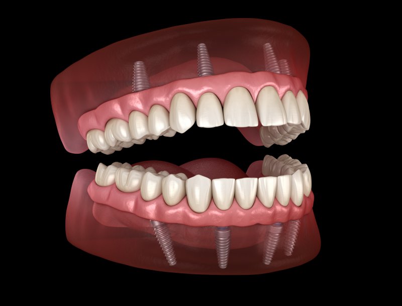 Illustration of implant dentures